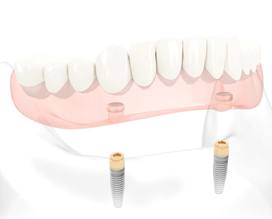 All-in-4 Implants